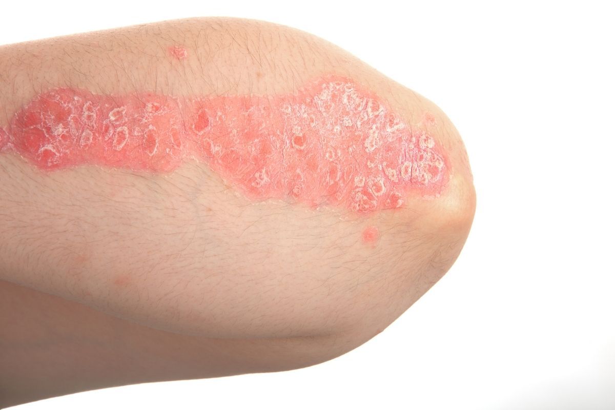 Psoriasi e alimentazione: cibi da evitare, sintomi, cause e stress