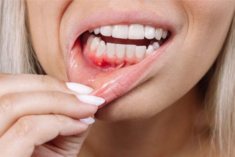Ragazza con ulcerazione sulla gengiva - cause delle afte in bocca