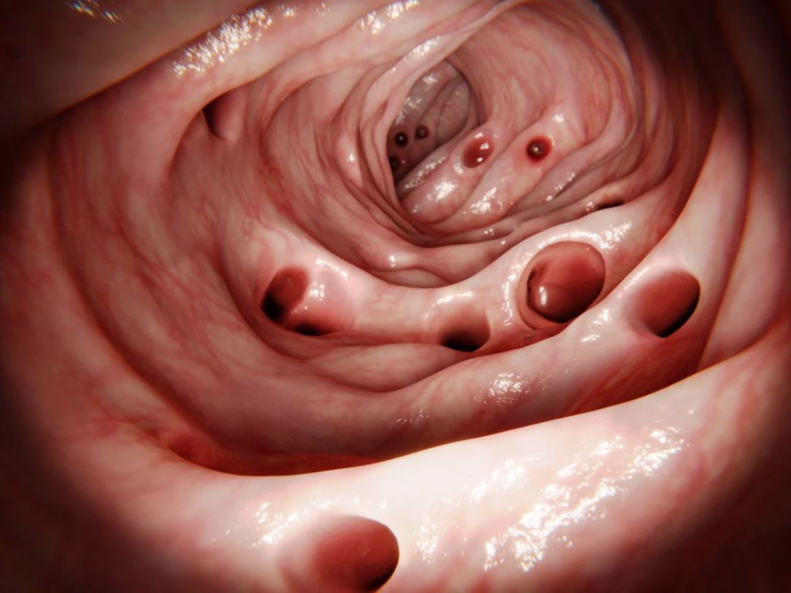 Diverticoli cosa mangiare e cosa non mangiare